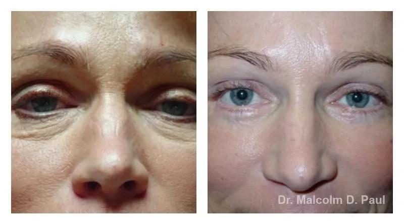 Pre+and+post+op+upper+and+lower+lid+blepharoplasties-+and+browpexy3-1920w