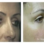 Pre+and+post+op+upper+and+lower+lid+blepharoplasties2-1920w