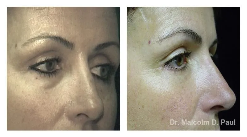 Pre+and+post+op+upper+and+lower+lid+blepharoplasties2-1920w