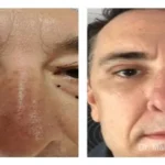 Pre+and+post+op+upper+and+lower+lid+blepharoplasties3-1920w