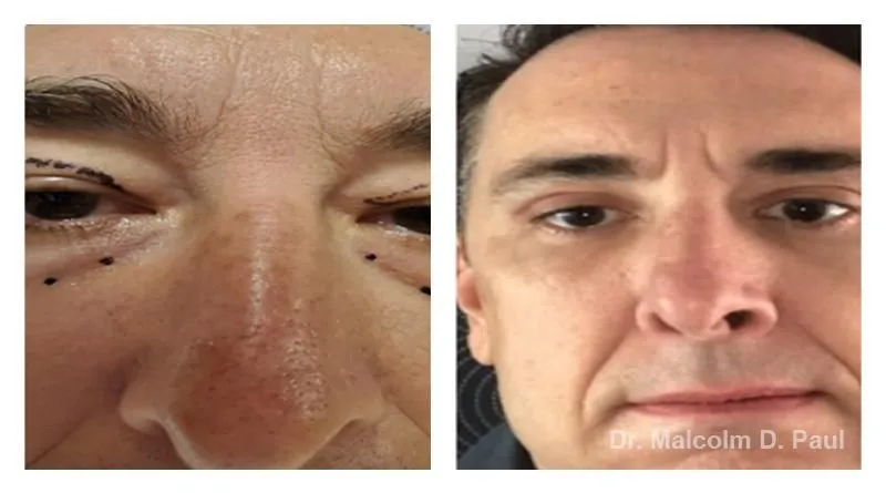 Pre+and+post+op+upper+and+lower+lid+blepharoplasties3-1920w