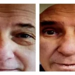 Pre+and+post+op+upper+and+lower+lid+blepharoplasties4-1920w