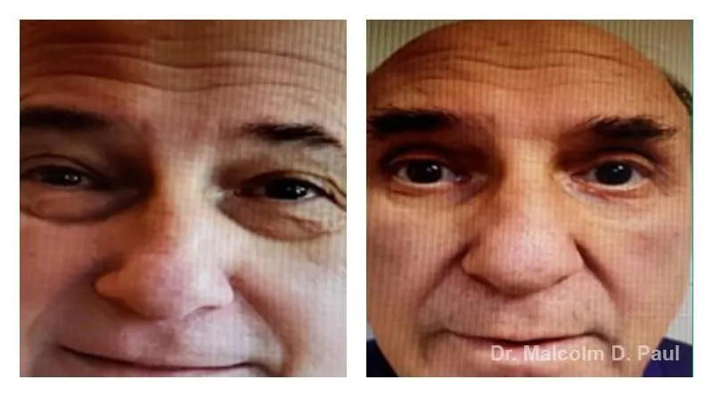 Pre+and+post+op+upper+and+lower+lid+blepharoplasties4-1920w