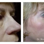Pre+and+post+op+upper+and+lower+lid+blepharoplasties5-1920w
