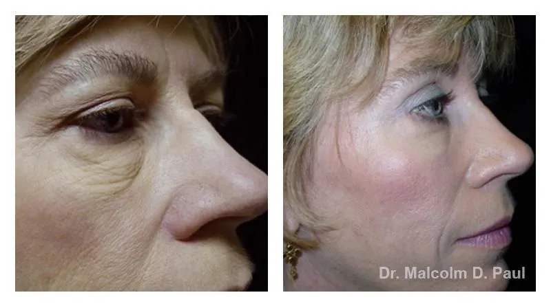 Pre+and+post+op+upper+and+lower+lid+blepharoplasties5-1920w