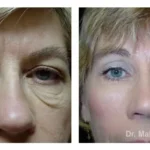 Pre+and+post+op+upper+and+lower+lid+blepharoplasties6-1920w