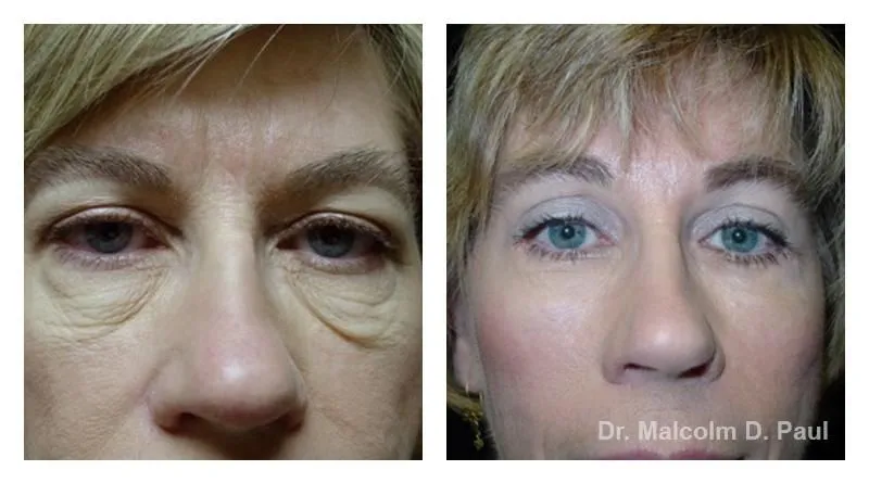 Pre+and+post+op+upper+and+lower+lid+blepharoplasties6-1920w
