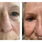 Pre+and+post+op+upper+and+lower+lid+blepharoplasties7-1920w
