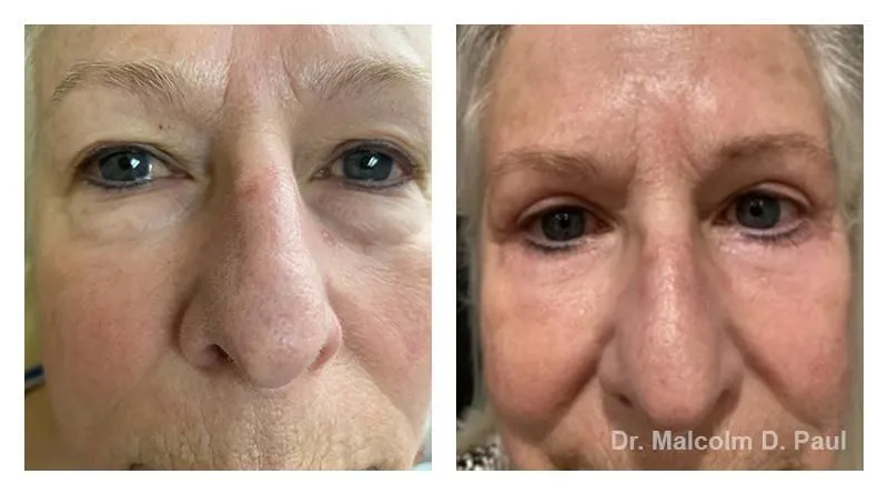 Pre+and+post+op+upper+and+lower+lid+blepharoplasties7-1920w