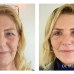 Pre+and+post+op+upper+and+lower+lid+blepharoplasties8-1920w