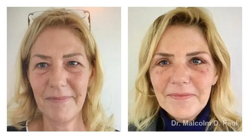 Pre+and+post+op+upper+and+lower+lid+blepharoplasties8-1920w