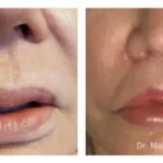 Pre+and+post+op+upper+lip+lift-1920w