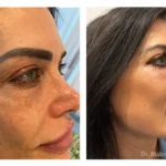 Vertical+Cheek+Lift-1920w