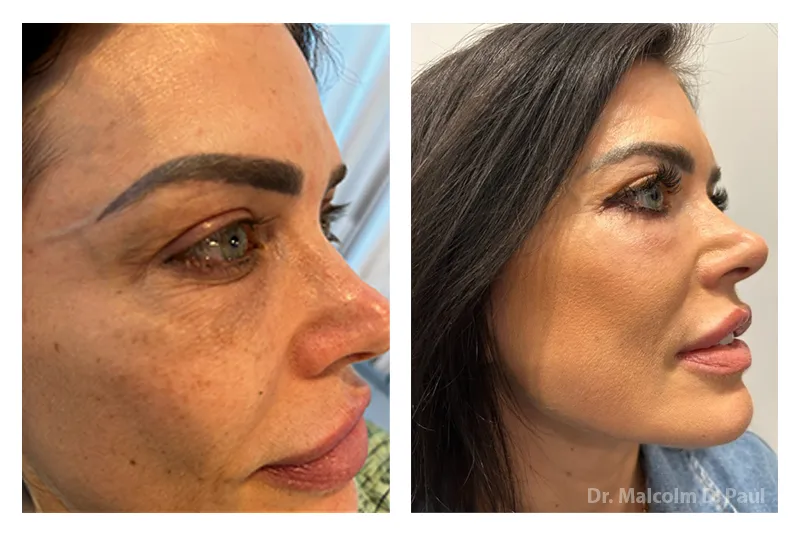 Vertical+Cheek+Lift-1920w