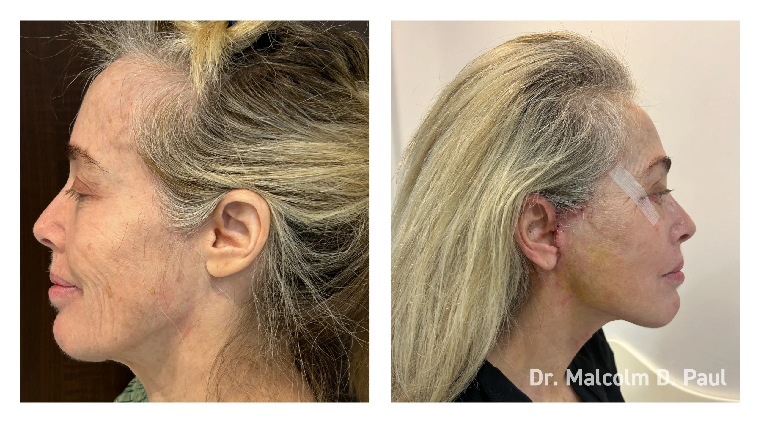 Before&After_08