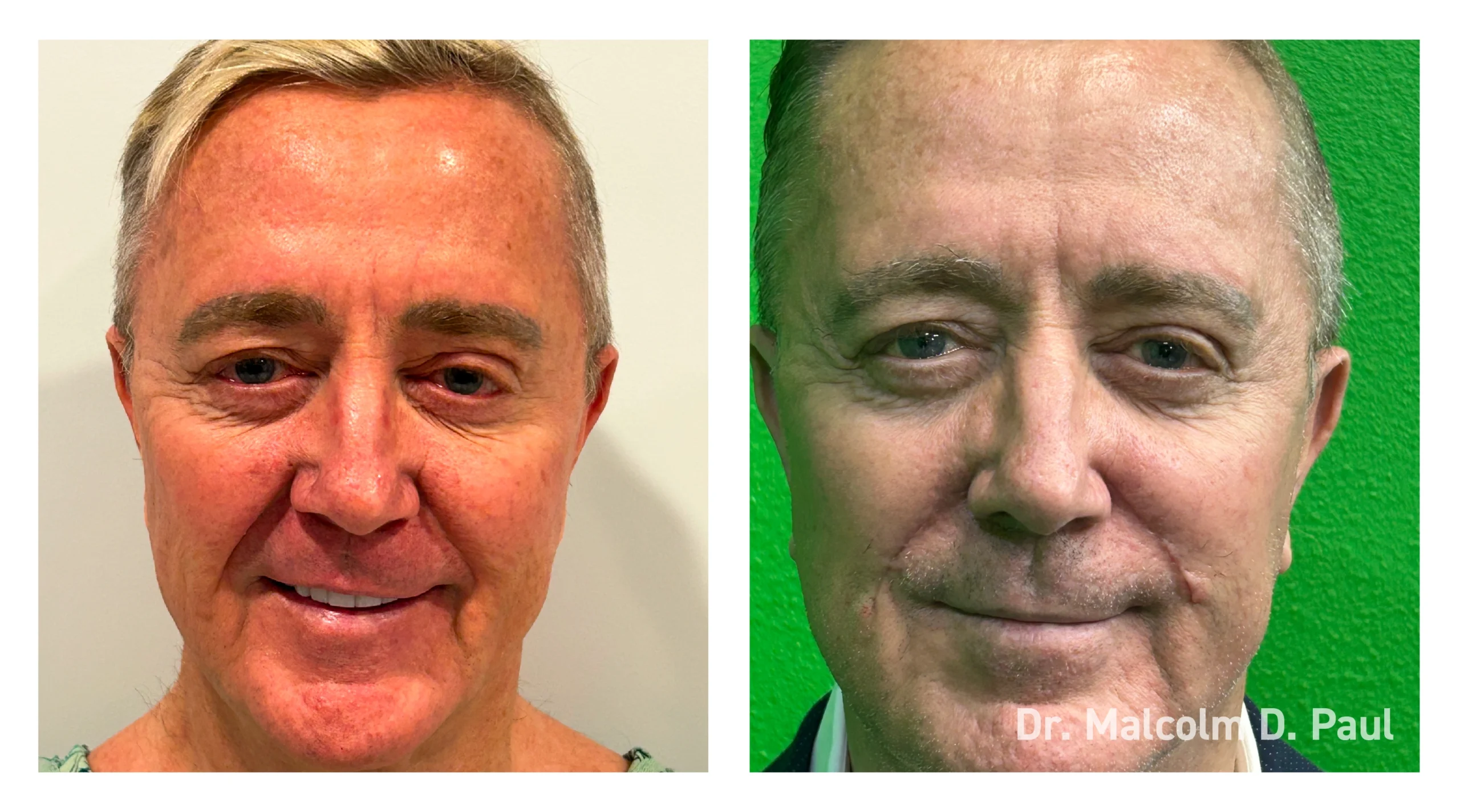 Before&After_09