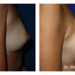 Before&After_15