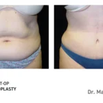 Pre&Post-Op_Abdominoplasty_01