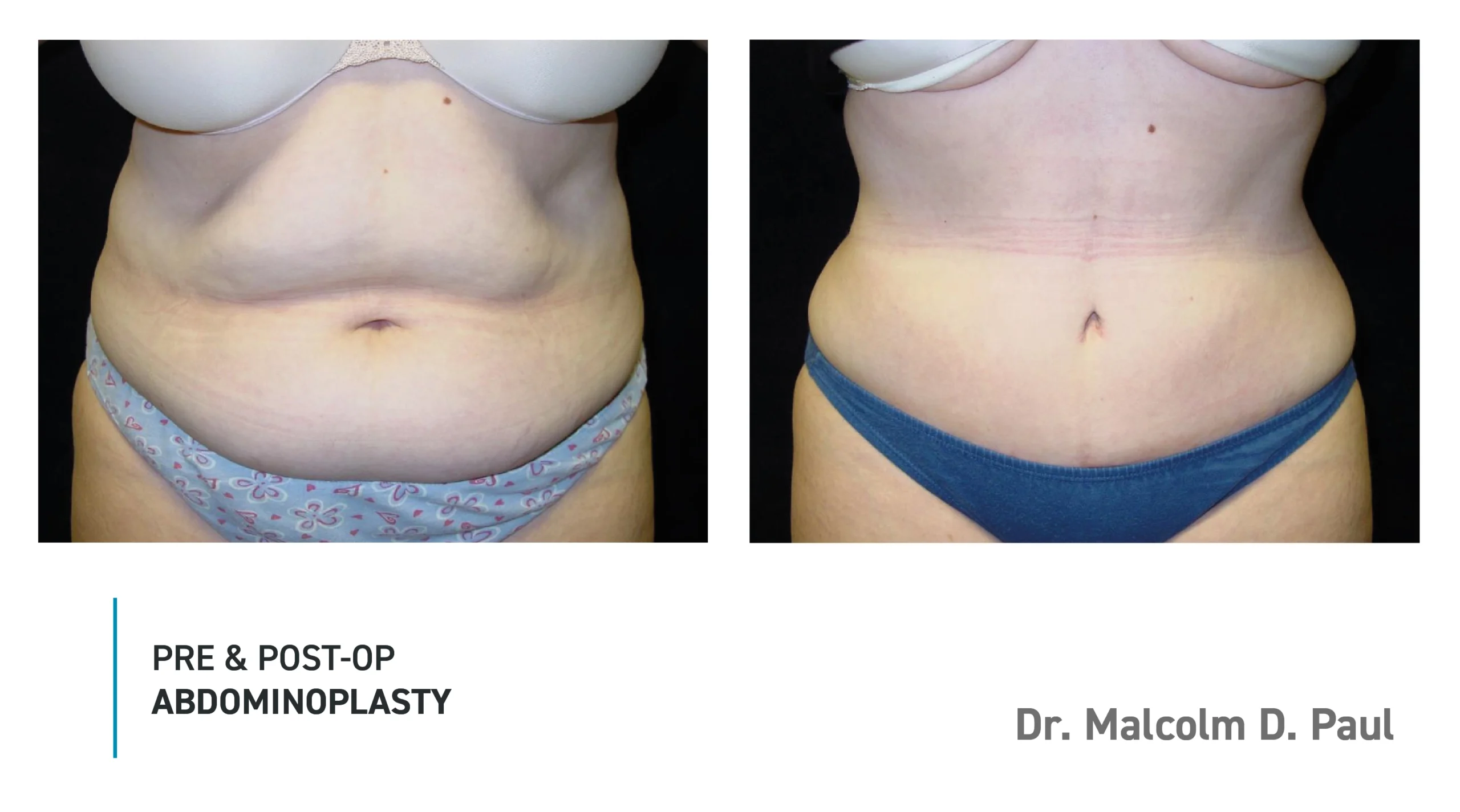 Pre&Post-Op_Abdominoplasty_01