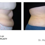 Pre&Post-Op_Abdominoplasty_02