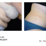 Pre&Post-Op_Abdominoplasty_03