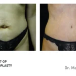 Pre&Post-Op_Abdominoplasty_04