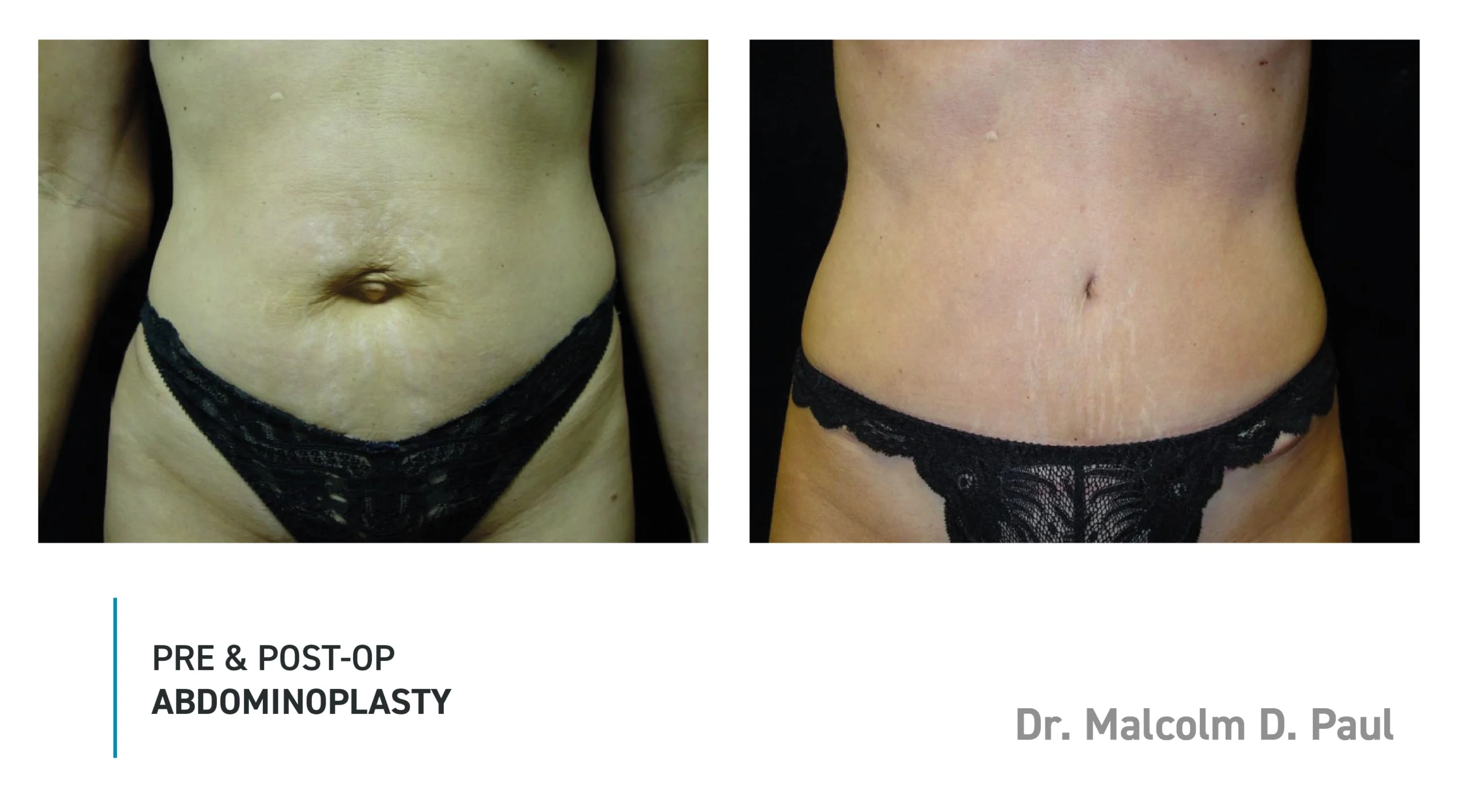 Pre&Post-Op_Abdominoplasty_04