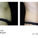 Pre&Post-Op_Abdominoplasty_05