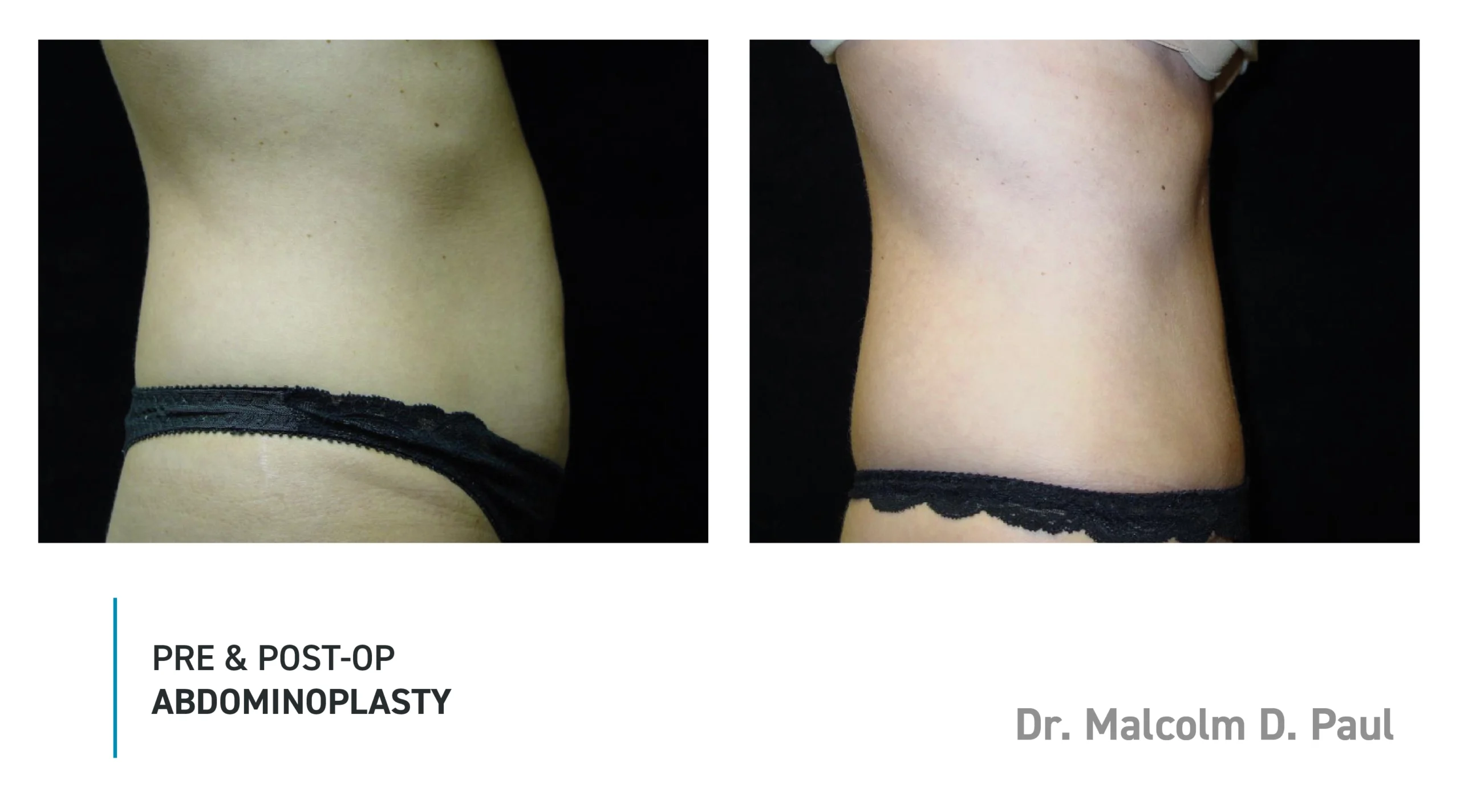 Pre&Post-Op_Abdominoplasty_05