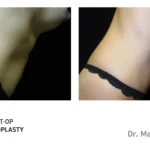 Pre&Post-Op_Abdominoplasty_06