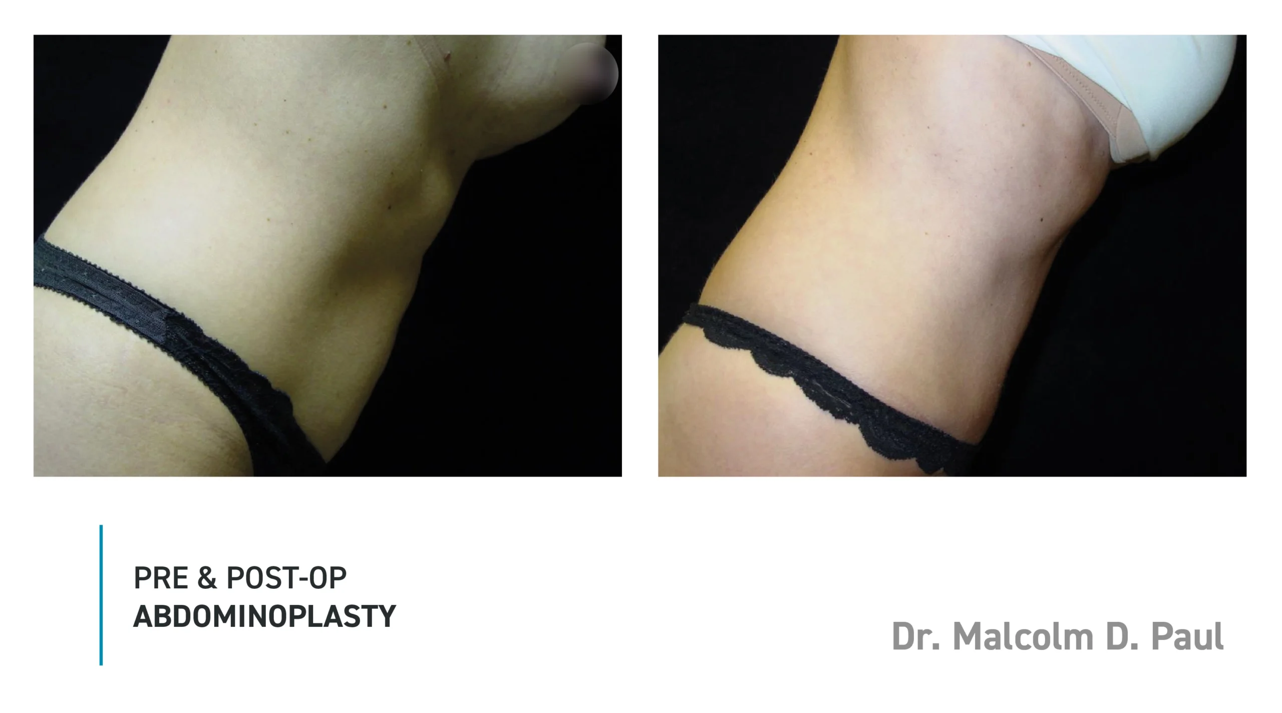 Pre&Post-Op_Abdominoplasty_06