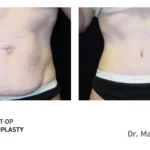 Pre&Post-Op_Abdominoplasty_07
