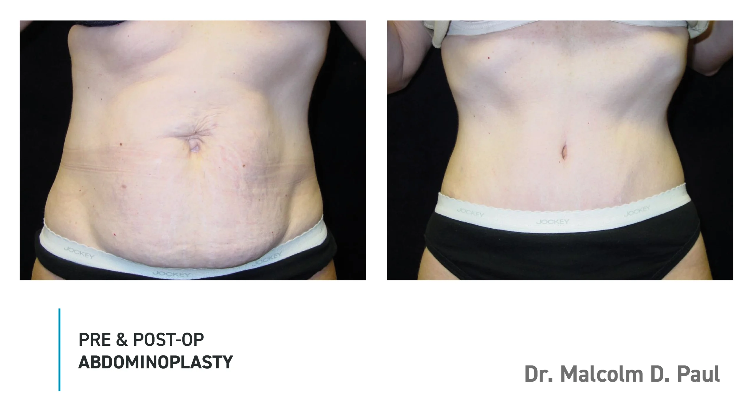 Pre&Post-Op_Abdominoplasty_07