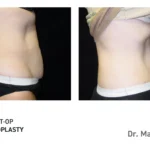 Pre&Post-Op_Abdominoplasty_08