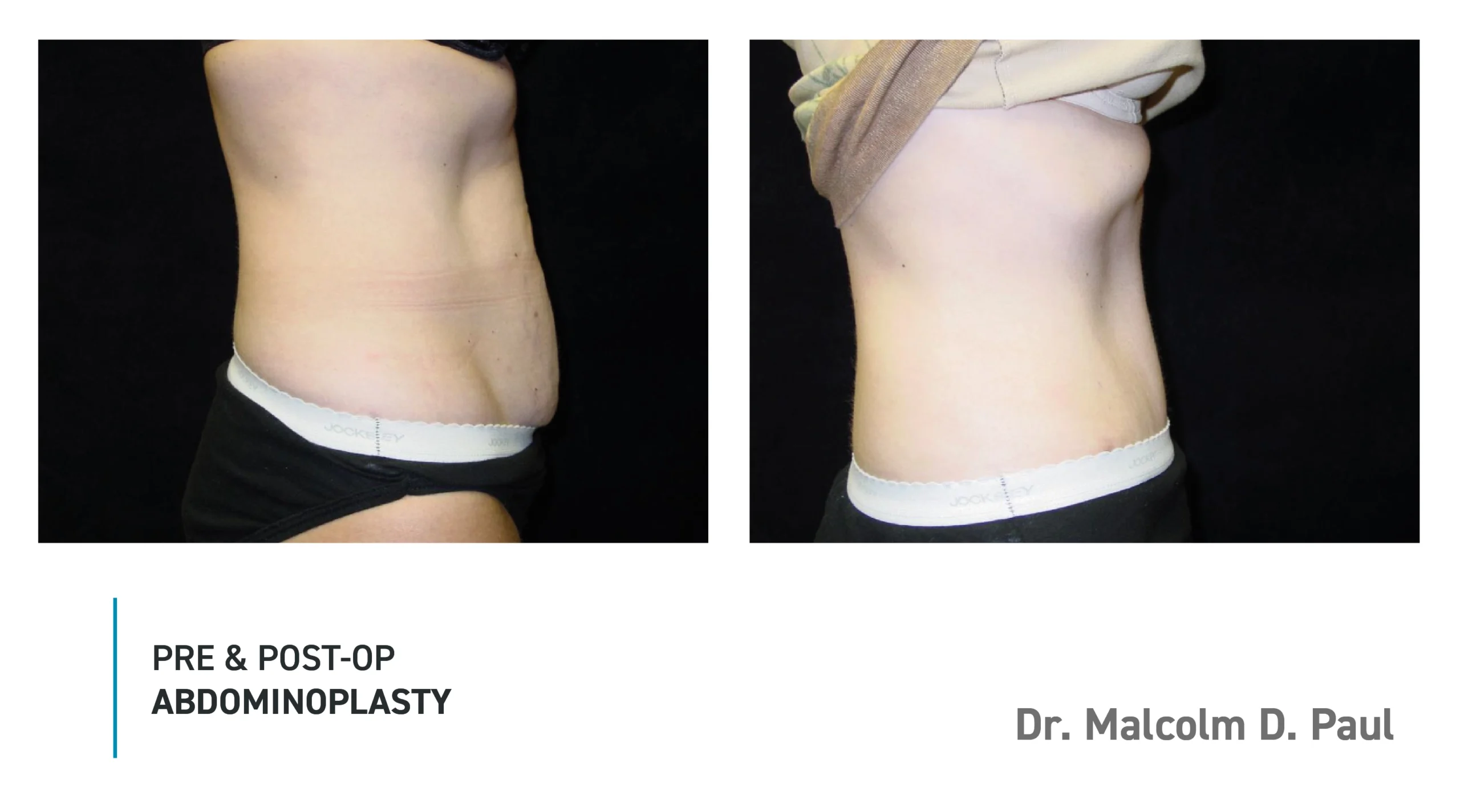 Pre&Post-Op_Abdominoplasty_08
