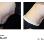 Pre&Post-Op_Abdominoplasty_09