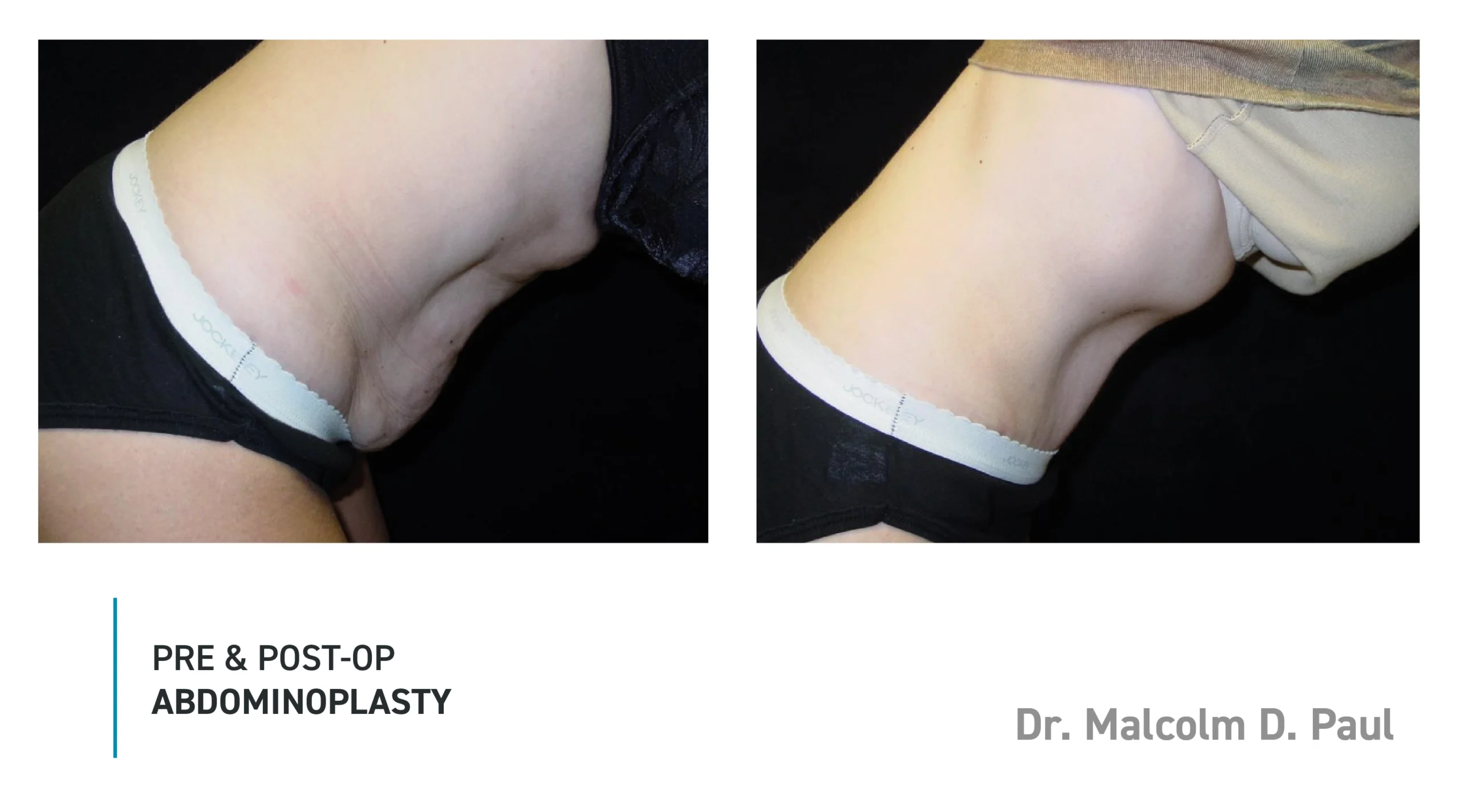 Pre&Post-Op_Abdominoplasty_09