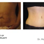 Pre&Post-Op_Abdominoplasty_10