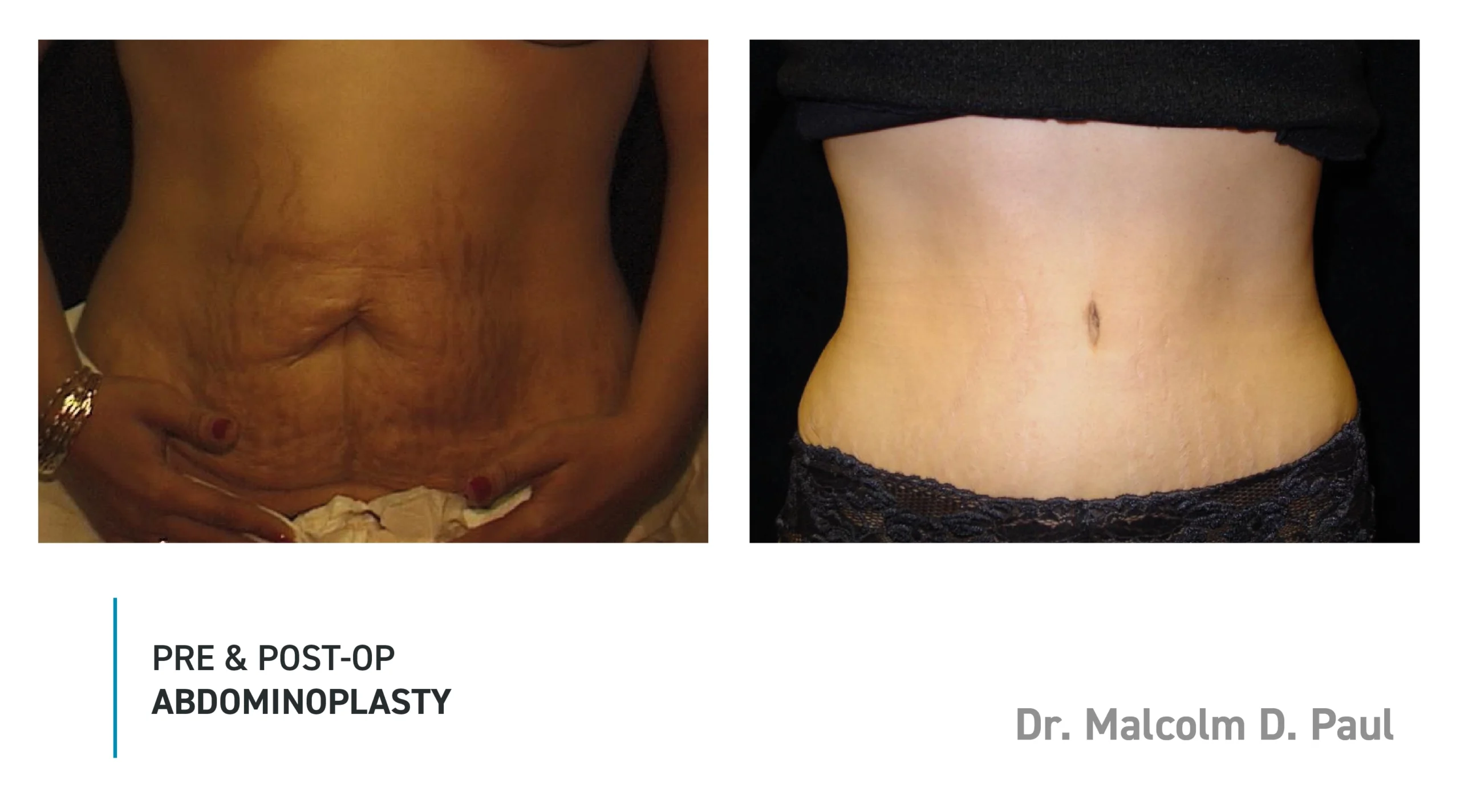 Pre&Post-Op_Abdominoplasty_10
