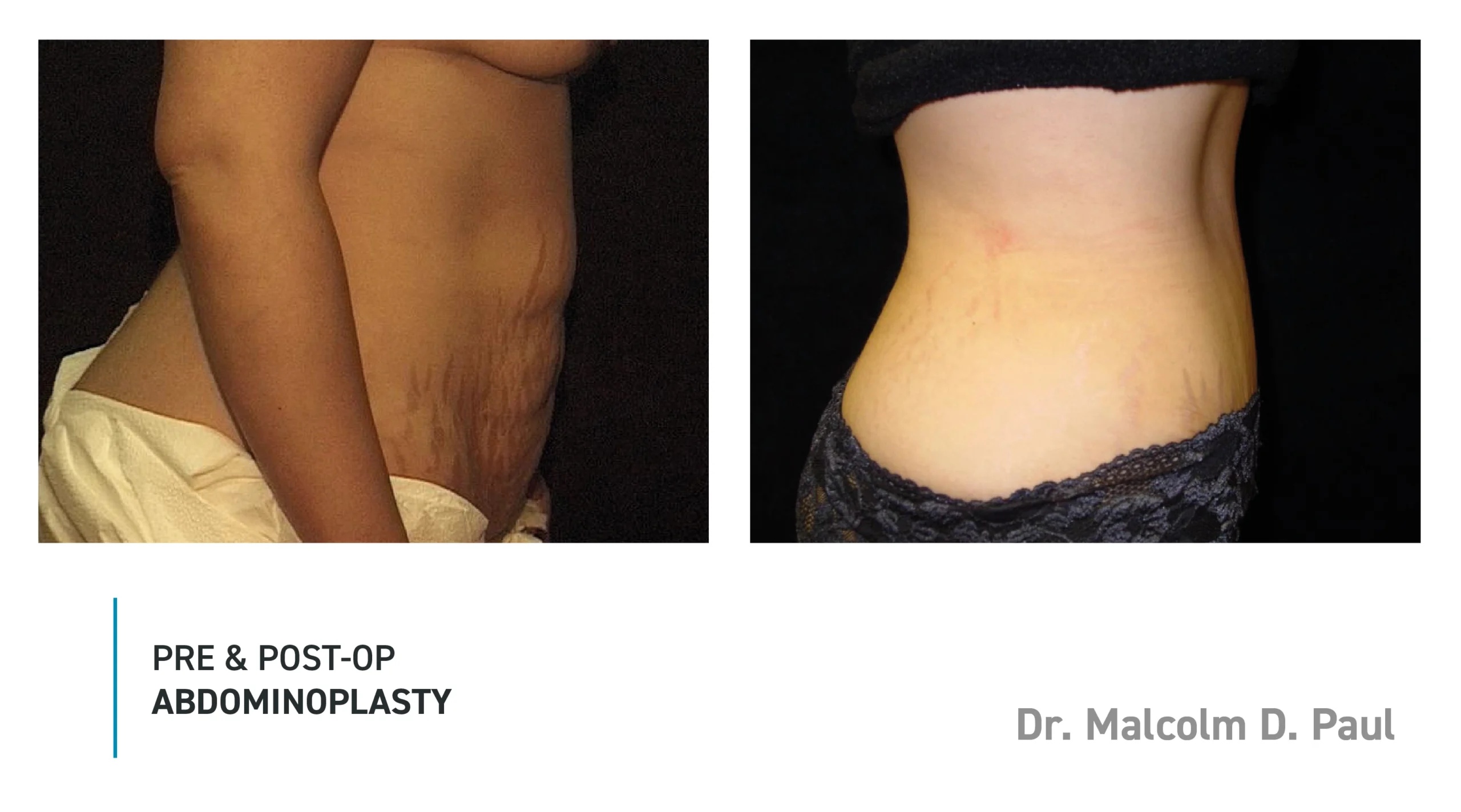 Pre&Post-Op_Abdominoplasty_11