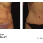 Pre&Post-Op_Abdominoplasty_12