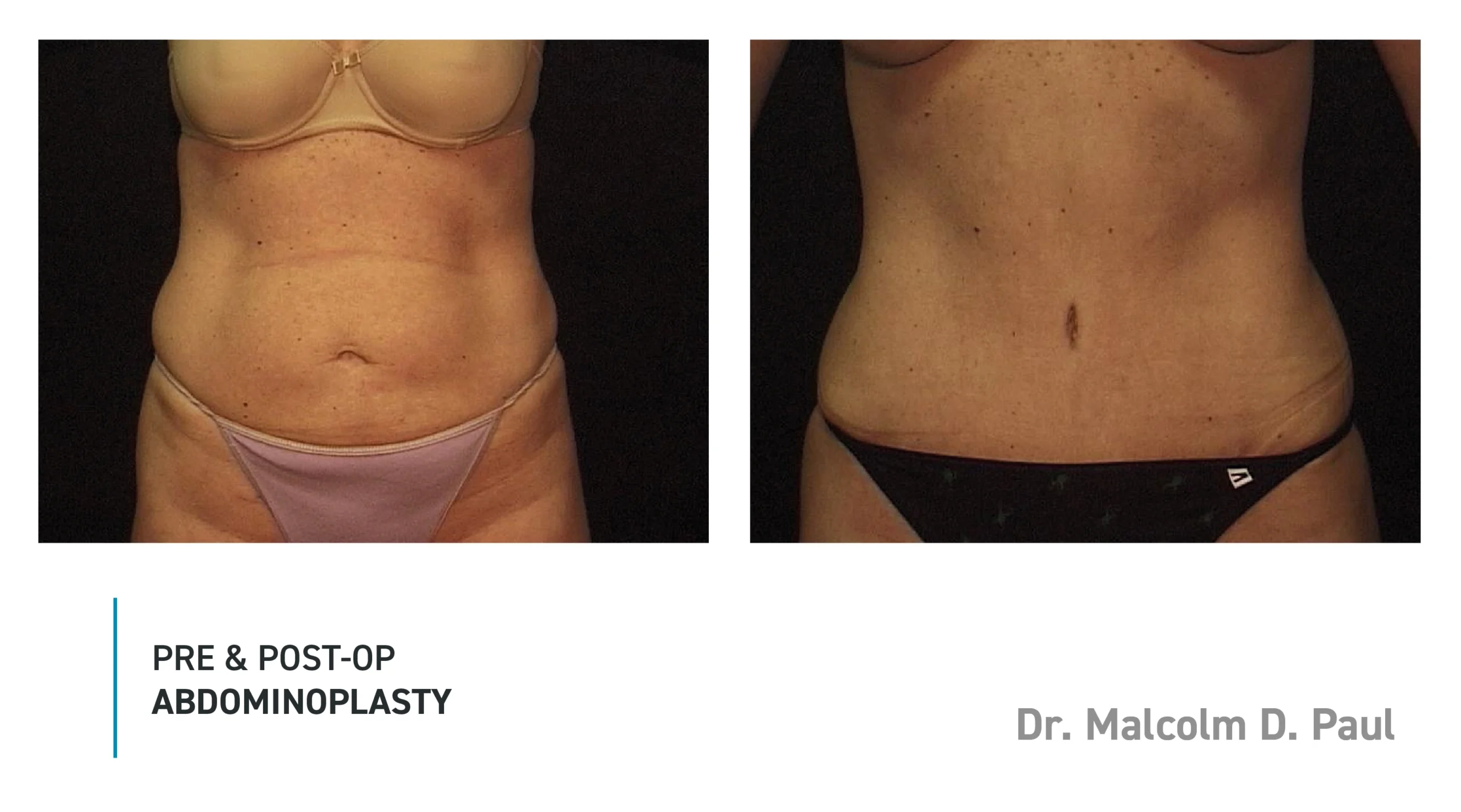 Pre&Post-Op_Abdominoplasty_12