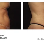 Pre&Post-Op_Abdominoplasty_13
