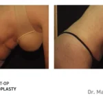 Pre&Post-Op_Abdominoplasty_14