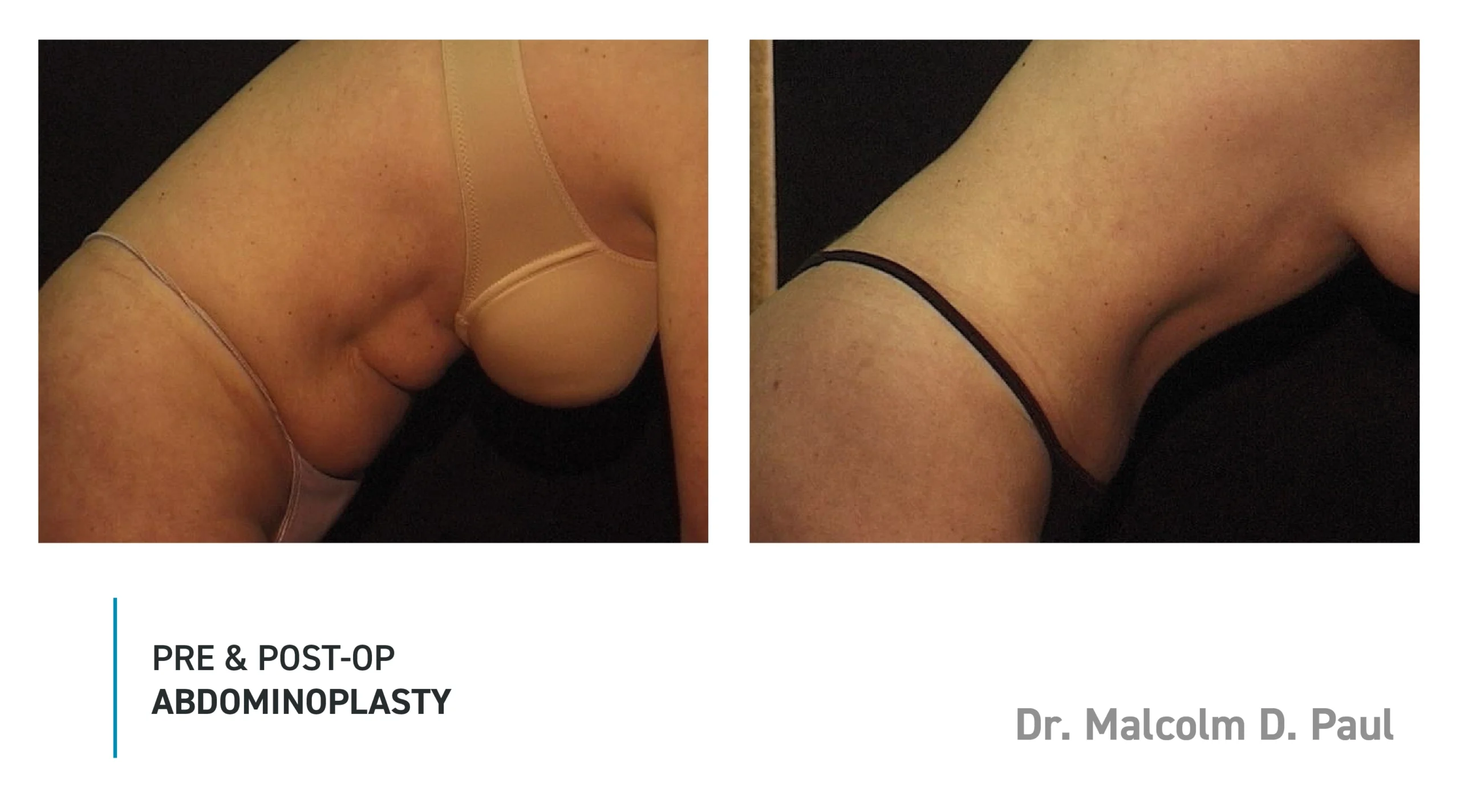 Pre&Post-Op_Abdominoplasty_14