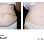 Pre&Post-Op_Abdominoplasty_15