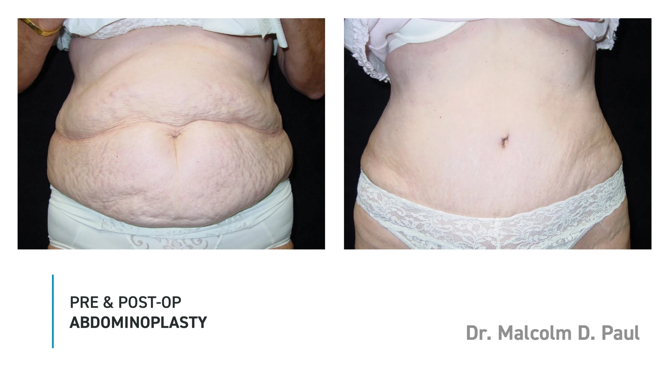 Pre&Post-Op_Abdominoplasty_15
