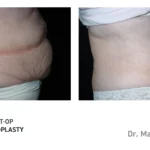 Pre&Post-Op_Abdominoplasty_16