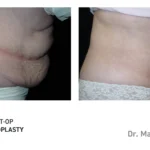 Pre&Post-Op_Abdominoplasty_17