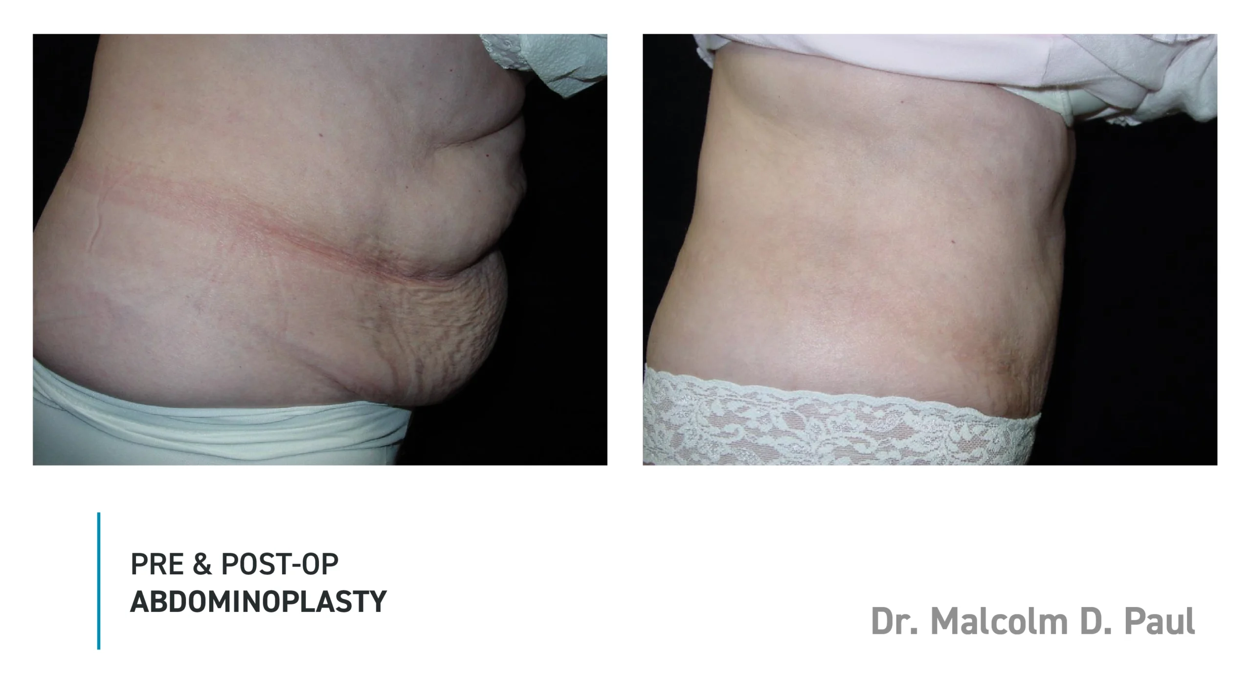 Pre&Post-Op_Abdominoplasty_17